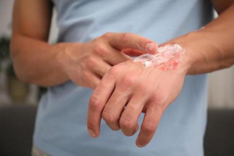 Burn Injuries: When Legal Help Becomes Necessary
